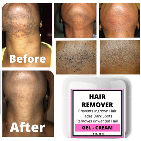 Ingrown Hair Removal