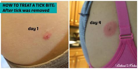 Tick Bite Treatment Home Remedy