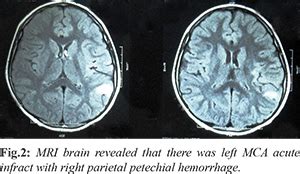 Varied Neurological Presentations of Common Krait Bite in an Adolescent