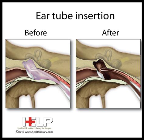 What Does A Tube In The Ear Do at Ian Stewart blog