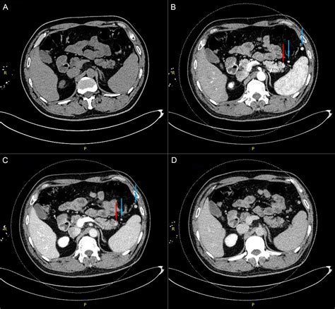 Accessory Pancreas Radiology at Vanessa Navarro blog