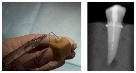 Assessment of Penetrability for Different Endodontic Irrigation ...