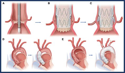 First-in-Human Endovascular Aortic Root Repair (Endo-Bentall) for Acute ...
