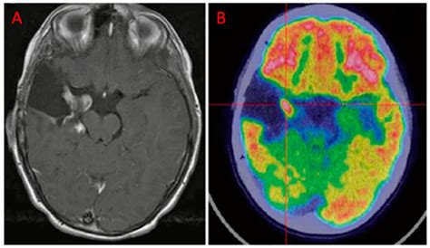 The Additional Value of 18F-FDG PET and MRI in Patients with Glioma: A ...