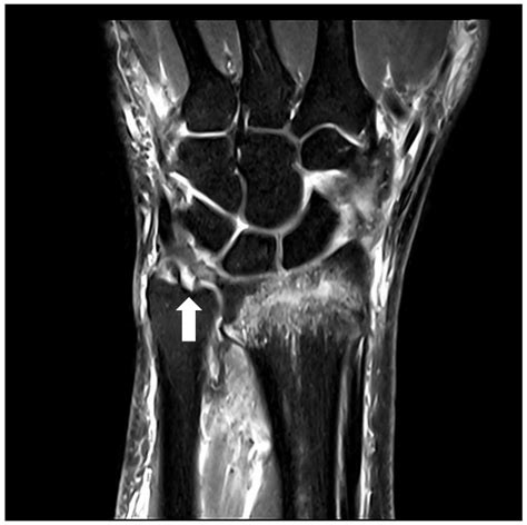 Triangular Fibrocartilage Complex Fracture Severity And Triangular