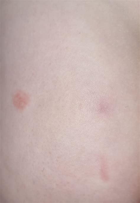 Beginning Stages Of Ringworm