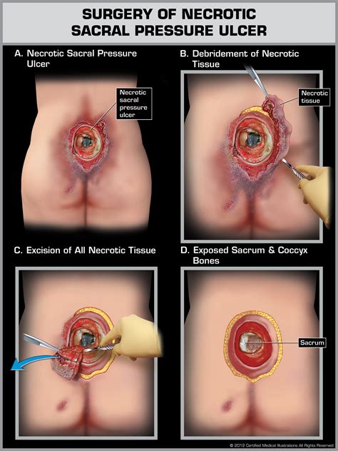 Sacral Pressure Ulcers in Nursing Homes | NJ Neglect Lawyer