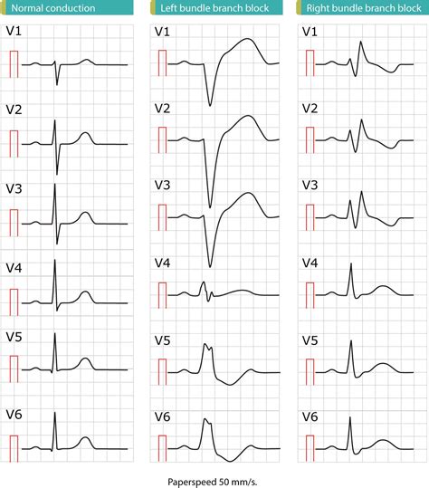 Left bundle branch block (LBBB): ECG criteria, causes, management – ECG ...