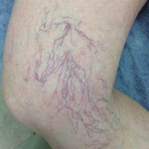 What are Spider Veins? — The Leg Vein Doctor | Brisbane | Varicose and Spider Vein Phlebology Clinic