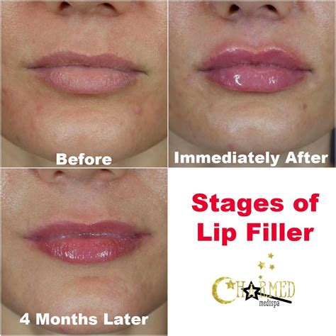 Stages Of Lip Injections And What To Expect At Charmed Medispa ...