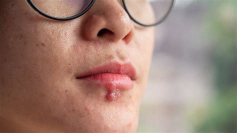 Sunburn Blister or Cold Sore? Telling the Difference (With Images) - GoodRx