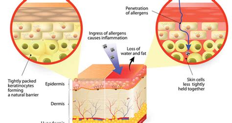 Skin Cancer Diagnosis, Treatment, and Removal - Acworth Dermatology