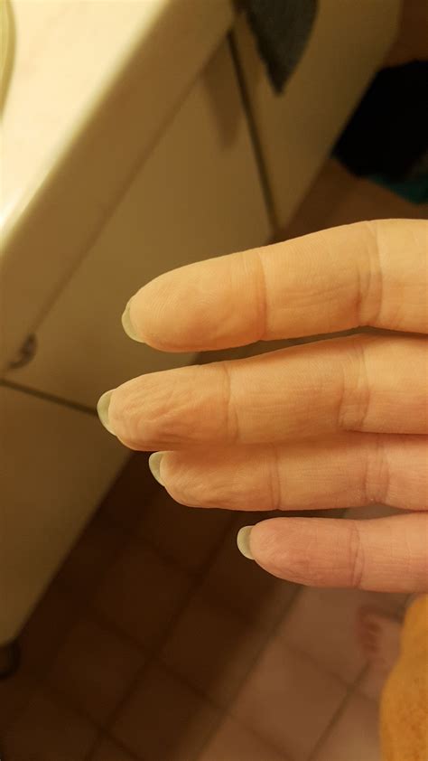 My trigger finger got frostbitten during a few cold winters in the ...