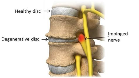 Degenerative Disc Disease: Progression, Symptoms, and Chiropractic