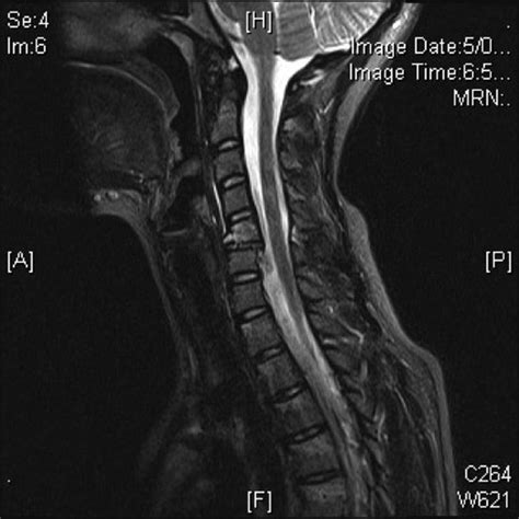 Flexion And Extension Teardrop Fracture at Donte Galiano blog