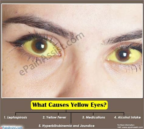What Causes Yellow Eyes and Home Remedies to Get Rid of it?