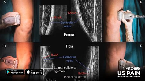 Múnla Nerve Femoral