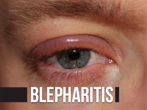 Bildergebnis für blepharitis symptome