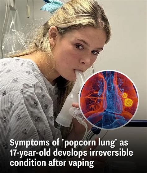 Symptoms of 'popcorn lung' as 17-year-old develops irreversible ...