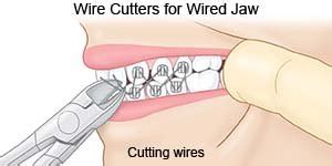 wiring a jaw shut
