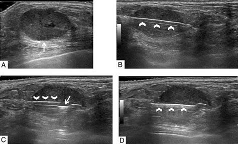 Ultrasound‐Guided Breast Biopsies - Bhatt - 2021 - Journal of Ultrasound in Medicine - Wiley ...