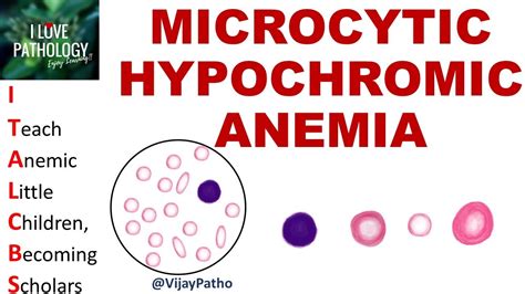 MICROCYTIC HYPOCHROMIC ANEMIA. Causes, Mechanism & Approach - YouTube