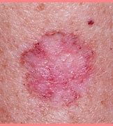 Image result for skin disease 皮肤疾病