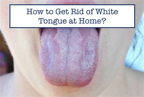 How to Get Rid of White Tongue at Home – B.WEISS Health