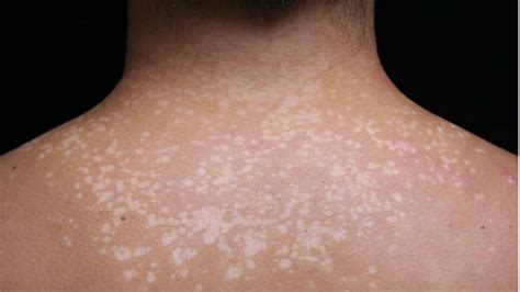 Miconazole For Tinea Versicolor