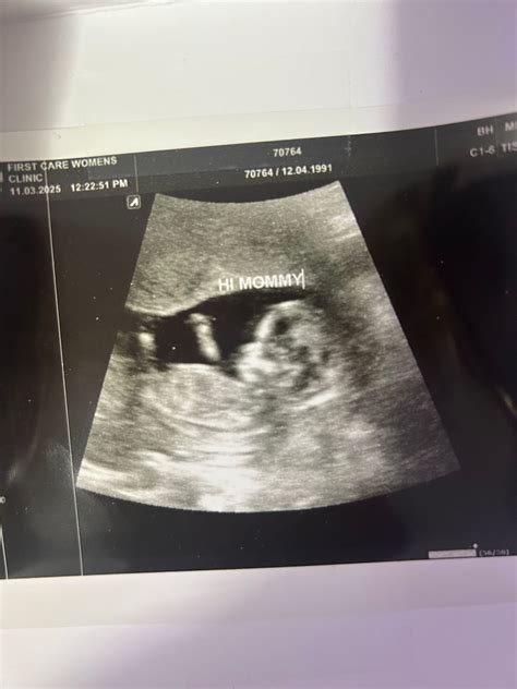 14 weeks 1 day ultrasound, do you think girl or boy? | BabyCenter