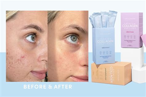 Does Hyaluronic Acid Help Collagen at Makayla Moffatt blog