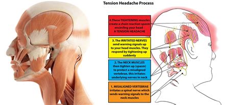 Chronic Tension Headache: A Guide on Symptoms and Treatment