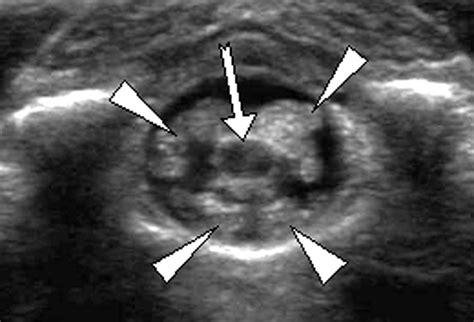 Why Do Sacral Dimples Occur at Susan Pietsch blog
