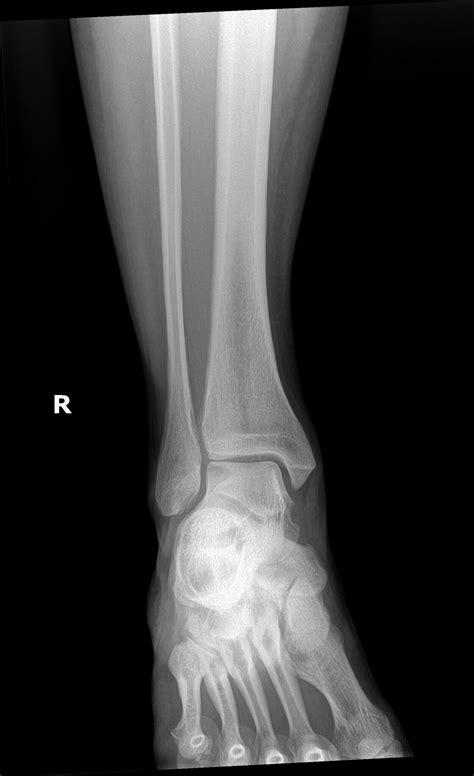 OrthoDx: Isolated Posterior Malleolar Fracture - Clinical Advisor