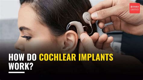How do Cochlear implants work?