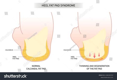 16 Cortisone Be Fat Images, Stock Photos & Vectors | Shutterstock