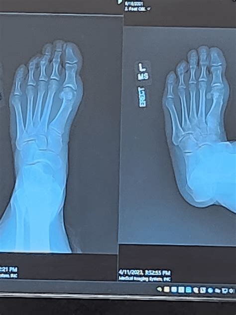 X-rays almost 5 weeks post surgery : r/bunions