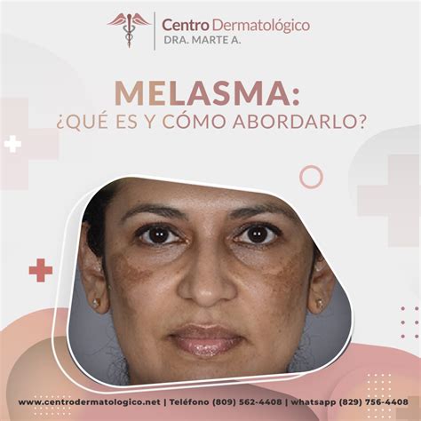 Melasma: Qué es, Síntomas y Diagnóstico - Centro Dermatológico Dra ...