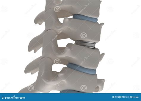 Lumbar Artificial Disc Replacement. Human Bone Anatomy. Royalty-Free ...
