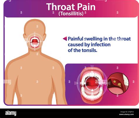 Illustration of throat pain caused by tonsillitis Stock Vector Image & Art - Alamy