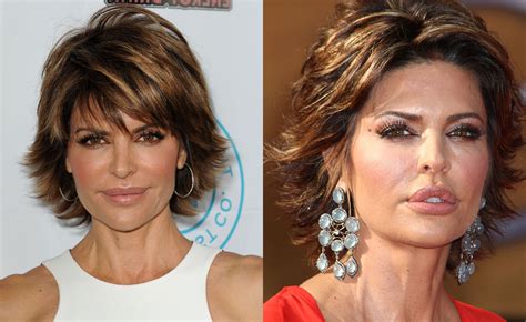 Lisa Rinna Plastic Surgery Before And After Face Photos