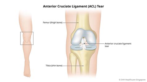 ACL Tear & Injury - Causes, Symptoms & Signs | Gleneagles Hospital