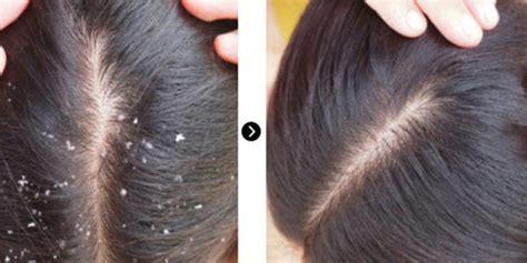 Buy Online Dandruff Free Shampoo | Anti Dandruff Shampoo – Orgatre.com