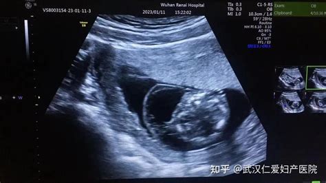 孕14周才做第一次产检！武汉仁爱妇产医院超声科及时筛查出胎儿严重畸形！ - 知乎