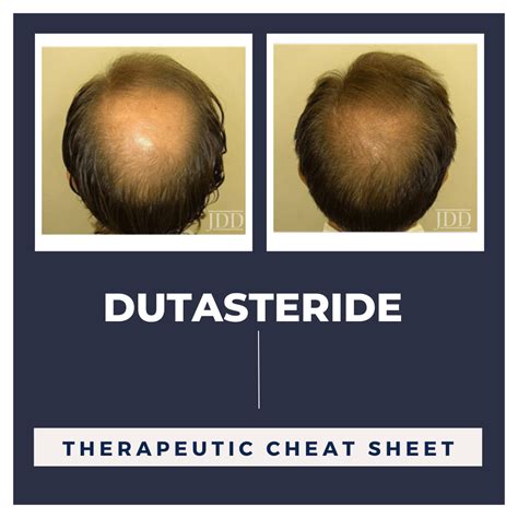 Dutasteride For Hair Loss