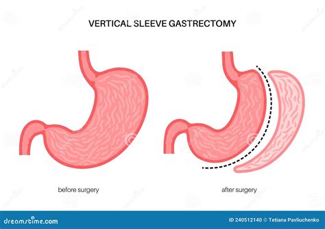 Lap Sleeve Gastrectomy Steps at Margaret Carlin blog