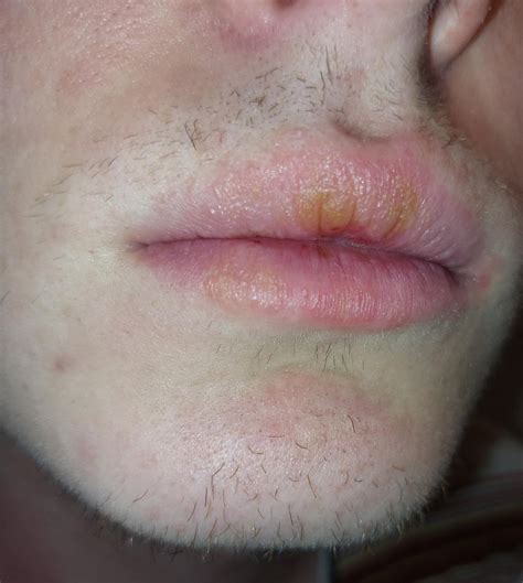 This appeared on my lips and feels a little itchy, what could it be ...
