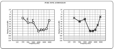 Bilateral Sensorineural Hearing Loss Congenital Nonprofound Bilateral