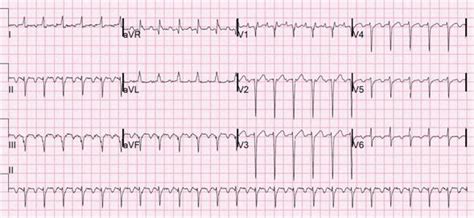 Image result for AFib Detection Algorithm