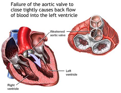 Aortic regurgitation causes, signs, symptoms, diagnosis & treatment